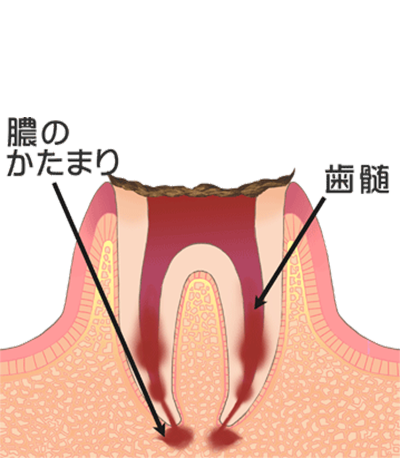 ⑤歯が完全に溶けているため、抜歯を行う必要があります